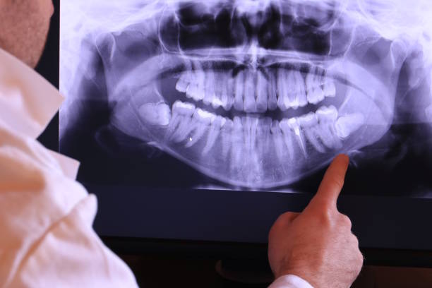 Best Emergency Wisdom Teeth Removal in South Boston, VA